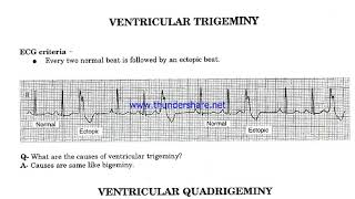 Ventricular Bigeminy Trigeminy amp Quadrigeminy [upl. by Waldack]