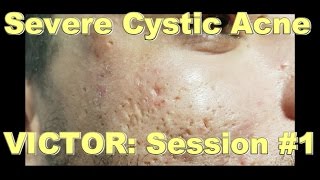 Severe Cystic Acne  Victor Session 1 [upl. by Remde657]