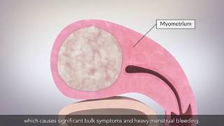 Laparoscopic myomectomy [upl. by Jehiah]