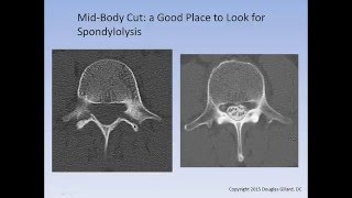 The Spondylolysis  Spondylolisthesis Lecture [upl. by Eniamrahc]