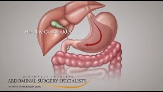 Gallbladder Symptoms [upl. by Rol]