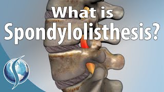 What Is Spondylolisthesis [upl. by Moersch669]