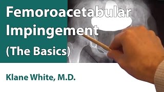 Femoroacetabular Impingement The Basics [upl. by Aicenet949]