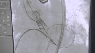 Medical Procedures  Stent Placement [upl. by Salvatore]