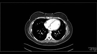 Abdominal Anatomy on Computed Tomography [upl. by Nyliac]