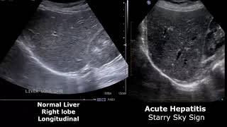 Ultrasound Video showing hemangioma in Liver [upl. by Hesta]