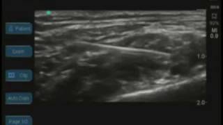 Ultrasound Guided Supraclavicular Nerve Block [upl. by Suhpoelc]