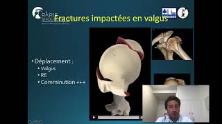 Fracture de Lhumérus Proximal [upl. by Garth631]