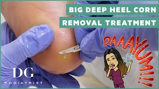 Big deep satisfying heel corn removal treatment on the foot  DG Podiatrist [upl. by Kahn]