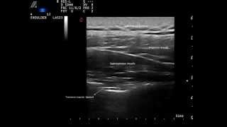 Ultrasound guided suprascapular nerve block by Murat Karkucak MD [upl. by Eanram815]