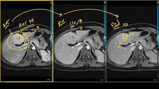 Focal Nodular Hyperplasia Typical Appearance on Liver MRI [upl. by Rolandson643]