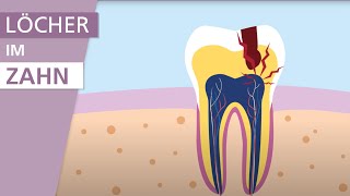 Was ist Karies  Stiftung Gesundheitswissen [upl. by Ednalrim]